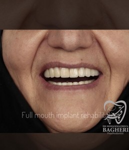 اصلاح-طرح-لبخند11