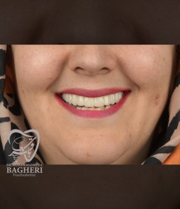اصلاح-طرح-لبخند7