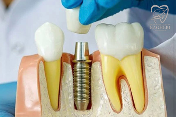 ایمپلنت دندان در ولنجک - دکتر باقری