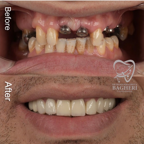 عکس ایمپلنت دندان قبل و بعد - دکتر باقری