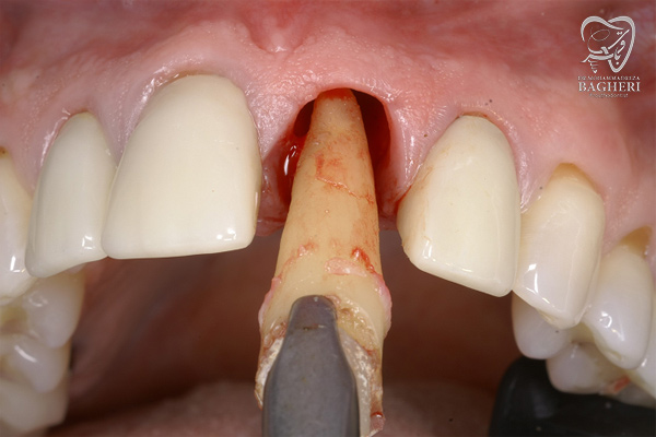 ایمپلنت دندان فوری در تهران - دکتر باقری