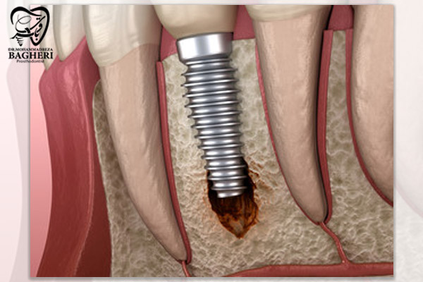 درمان پری ایمپلنتایتیس در تهران - دکتر محمدرضا باقری