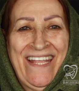 بهترین سن برای ایمپلنت دندان