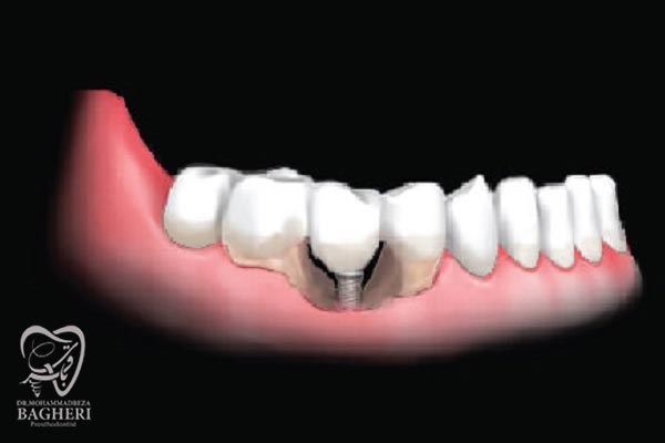 پس زدن ایمپلنت دندان - دکتر محمدرضا باقری