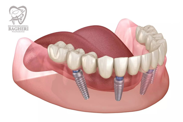 ایمپلنت تمام دندان ها
