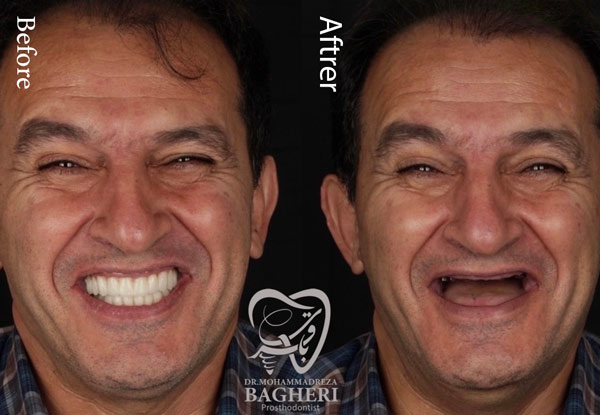 عکس ایمپلنت دندان قبل و بعد - دکتر باقری
