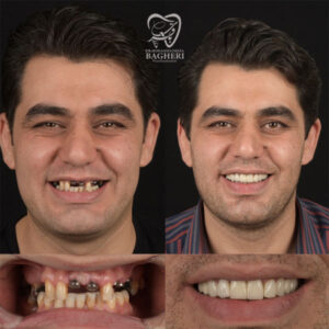 بهترین متخصص ایمپلنت دندان تهران - دکتر باقری
