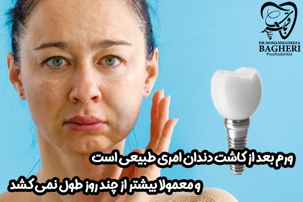 تورم ایمپلنت دندان - دکتر محمدرضا باقری