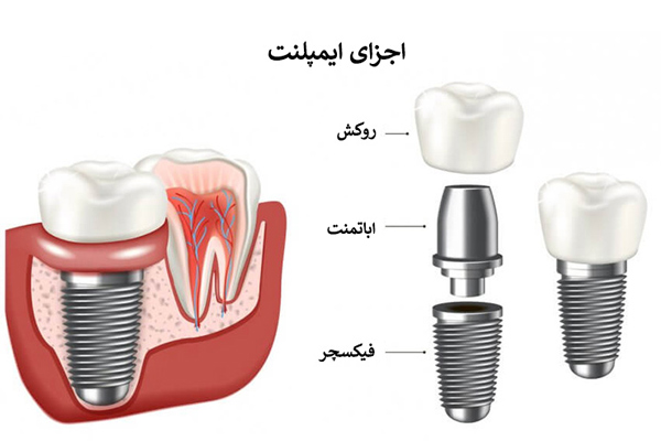 ایمپلنت دندان در تهران - دکتر باقری