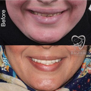 اصلاح طرح لبخند - دکتر محمدرضا باقری