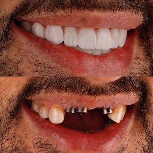 نمونه کارهای ایمپلنت دندان - دکتر محمدرضا باقری