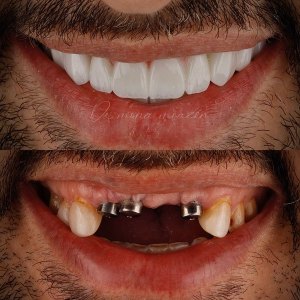 نمونه کارهای ایمپلنت دندان - دکتر محمدرضا باقری