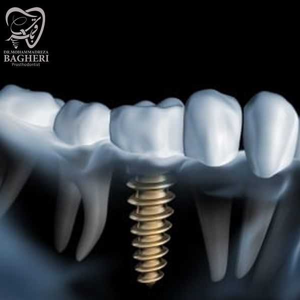 جوش خوردن ایمپلنت دندان - دکتر محمدرضا باقری