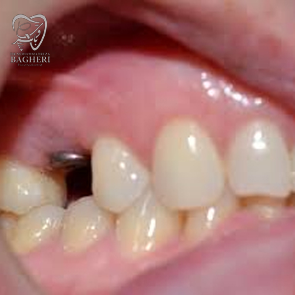 سیاه شدن لثه بعد از ایمپلنت دندان - دکتر محمد رضا باقری