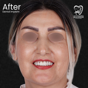 عکس بعد از ایمپلنت دندان - دکتر محمدرضا باقری