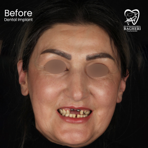 عکس قبل از ایمپلنت دندان - دکتر محمدرضا باقری