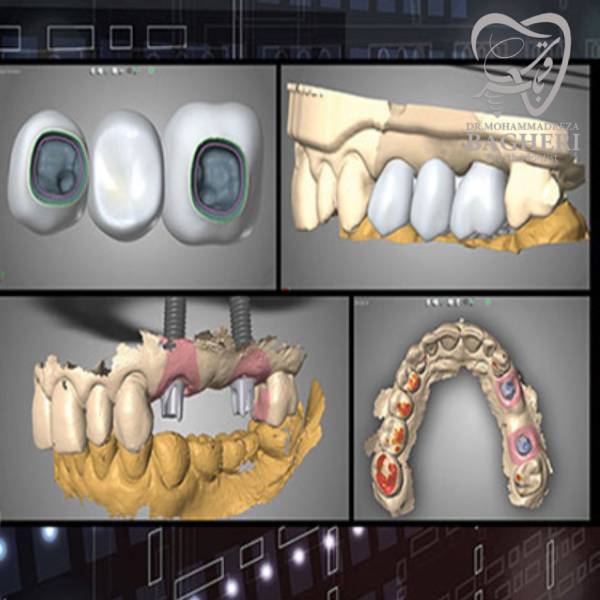 ایمپلنت دندان دیجیتال - دکتر باقری