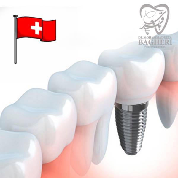 ایمپلنت دندان سوئیسی- دکتر محمدرضا باقری