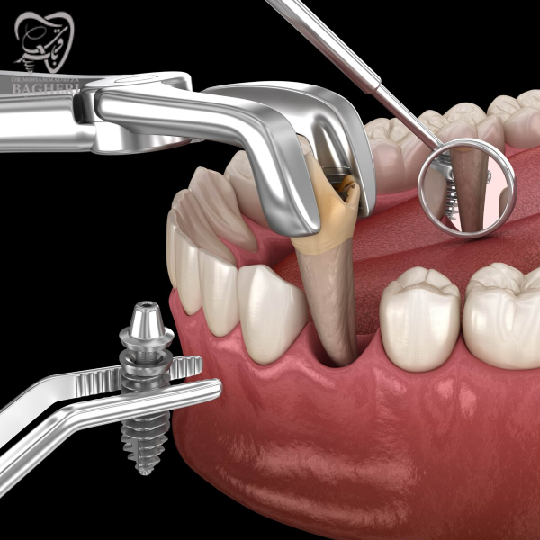 ایمپلنت دندان بعد از کشیدن دندان - دکتر محمدرضا باقری