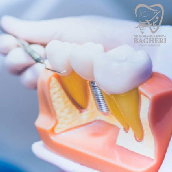 عوارض ایمپلنت دندان - محمدرضا باقری