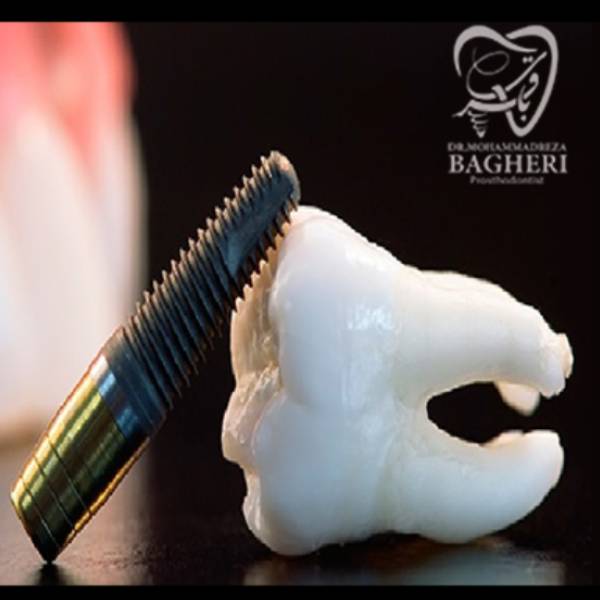 پس زدن ایمپلنت دندان - دکتر محمدرضا باقری