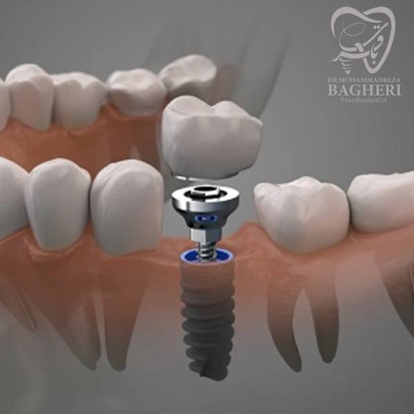 اوسئواینتگریشن - دکتر محمدرضا باقری