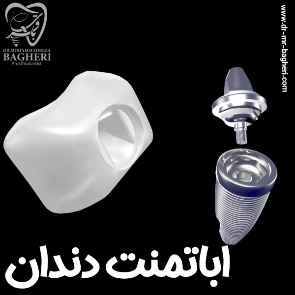 اباتمنت دندان - دکتر محمدرضا باقری
