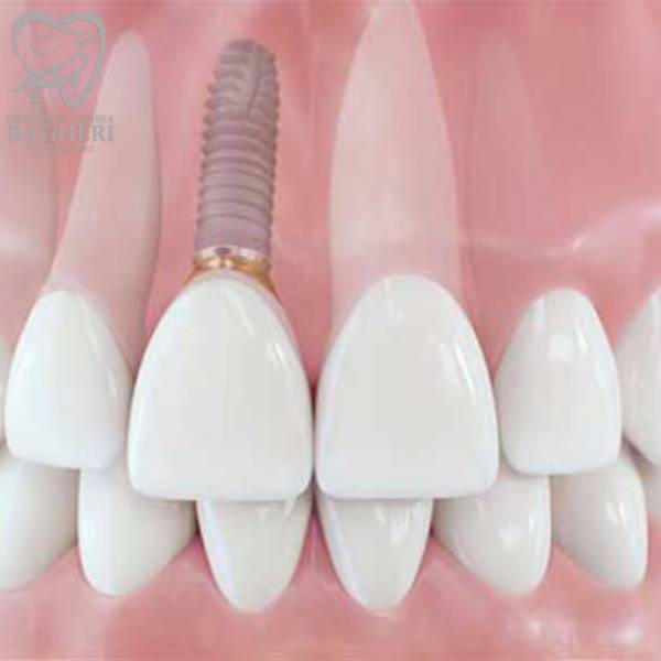 ایمپلنت دندان جلو - دکتر محمدرضا باقری
